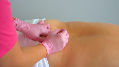 Cupping And Dry Needling